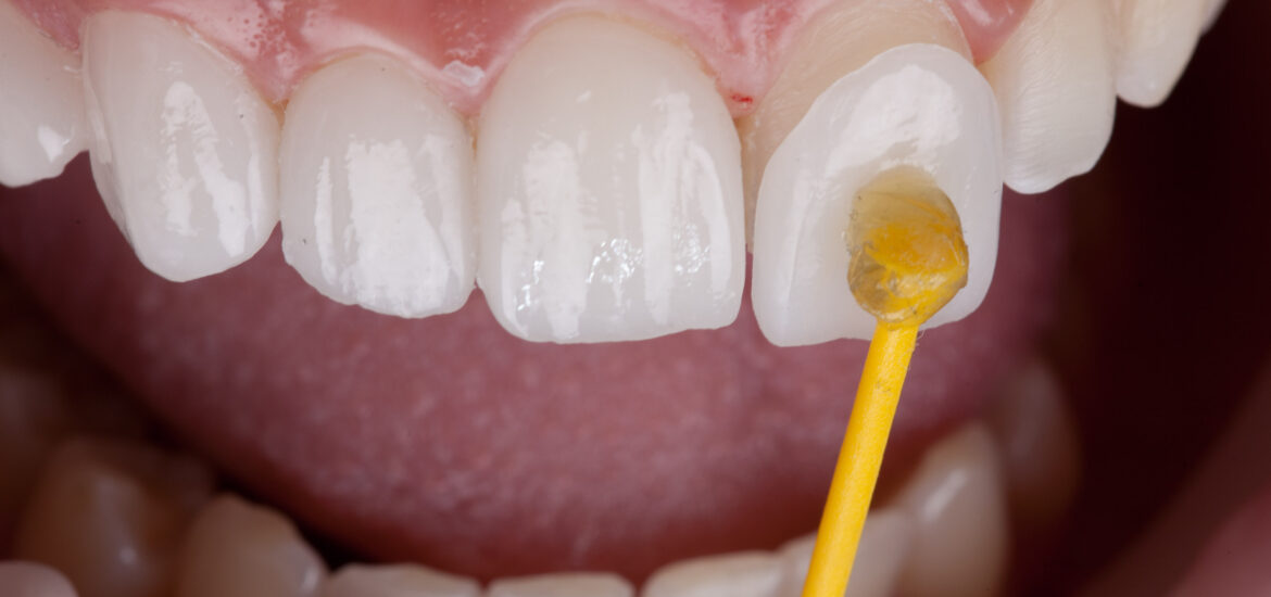 close up application of a dental veneer