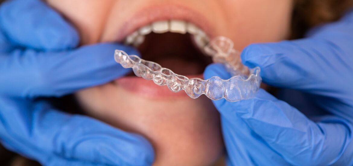 close-up of a dentist fitting a woman's clear aligners in her mouth