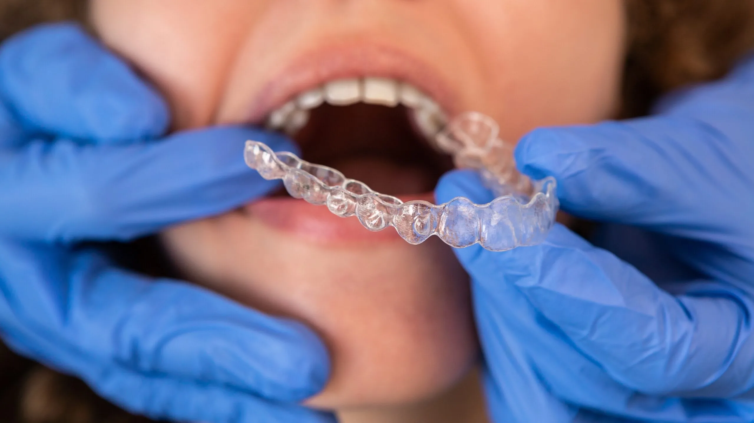 close-up of a dentist fitting a woman's clear aligners in her mouth