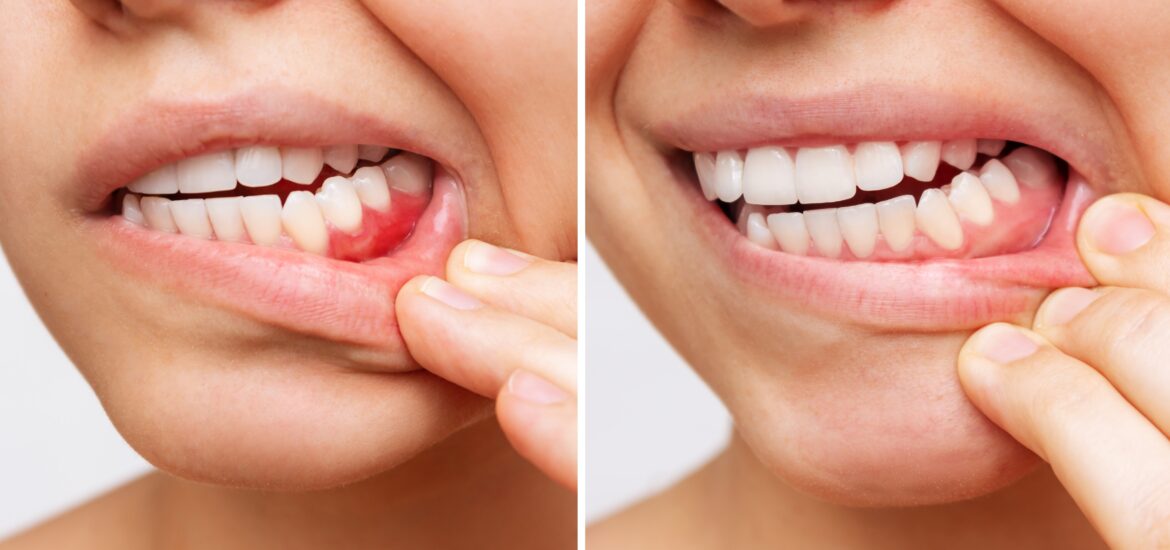side by side of gum disease progression