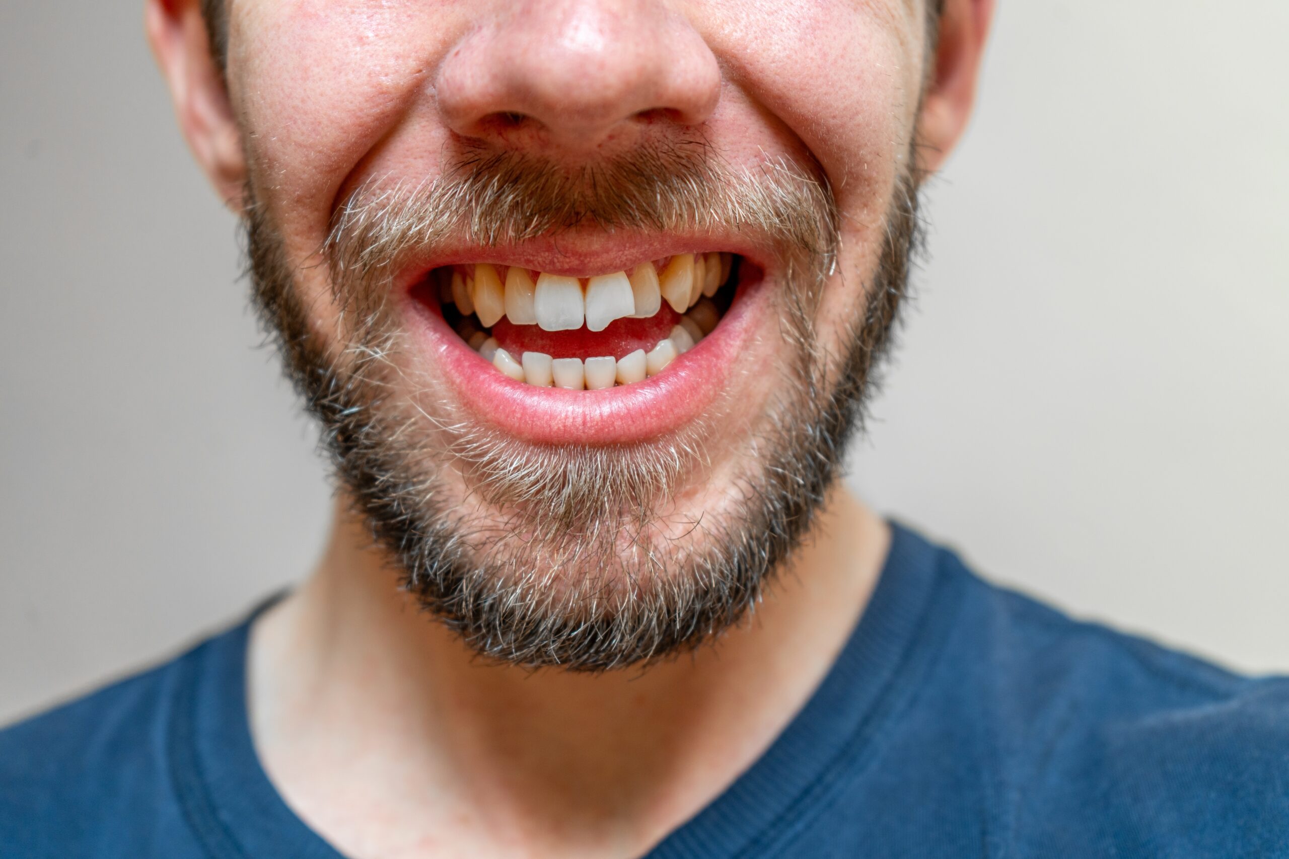 close up of a broken tooth, young smiling