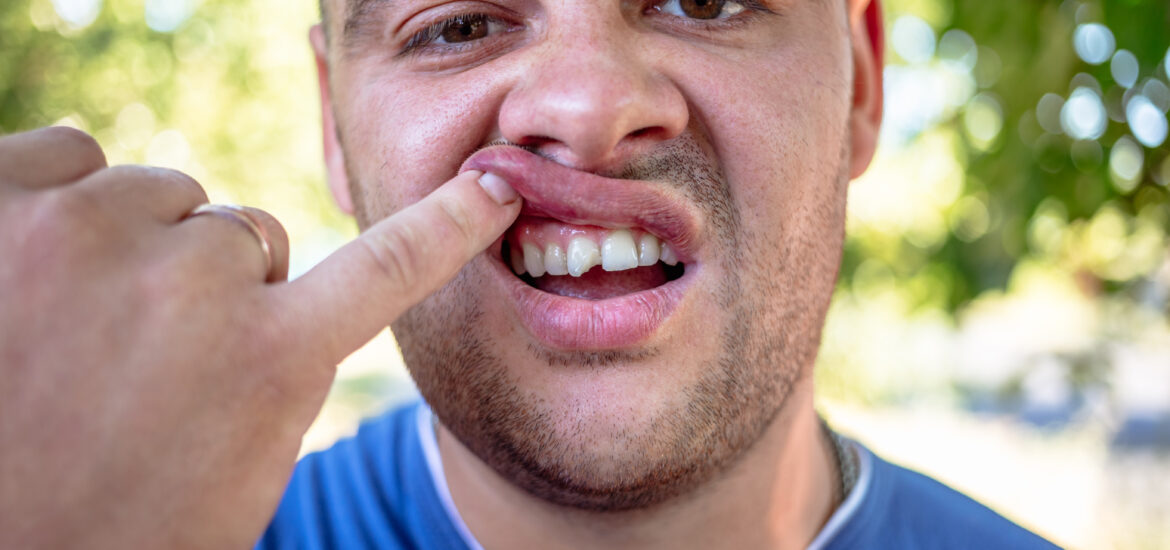young man in blue shirt exposing his chipped front tooth