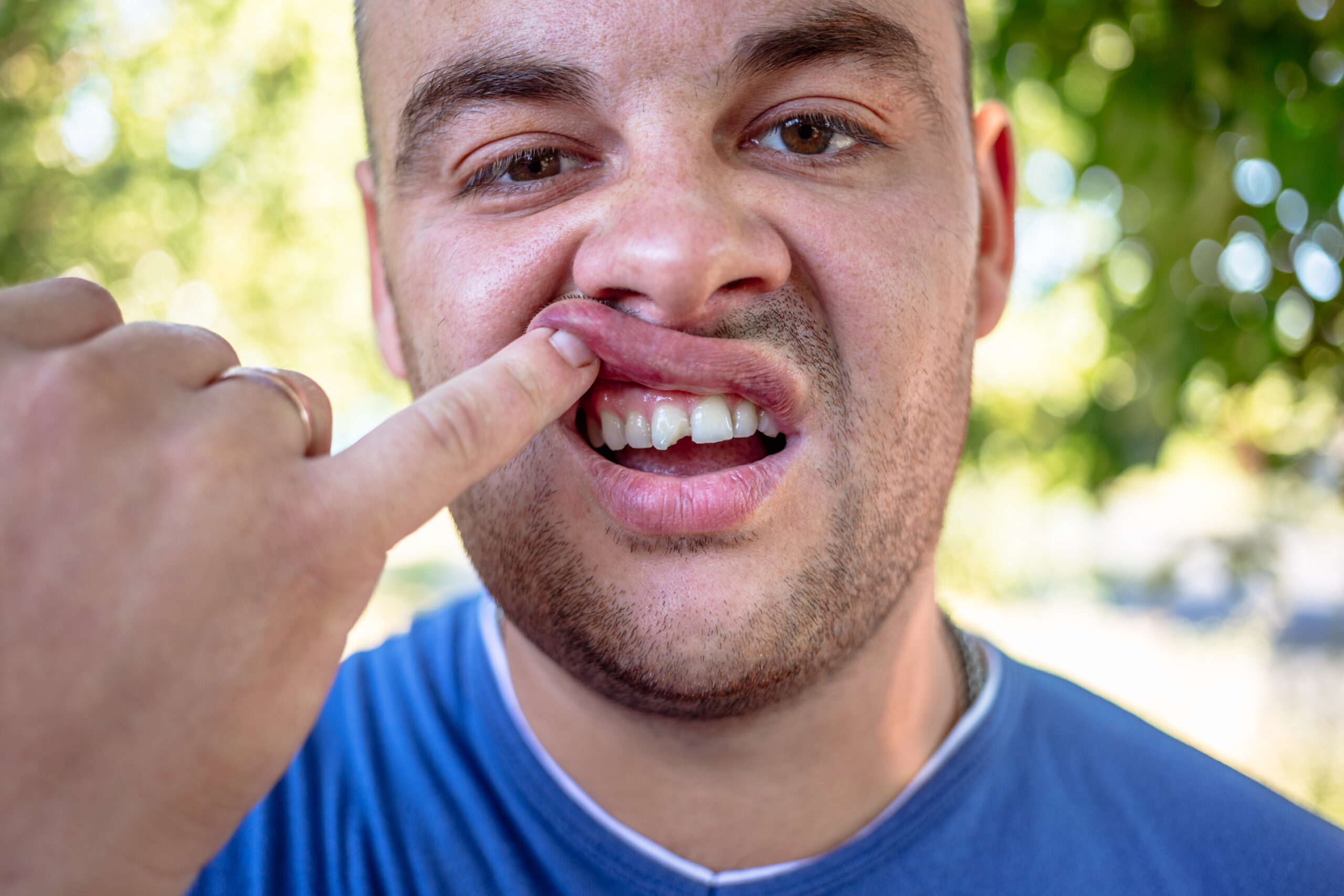 young man in blue shirt exposing his chipped front tooth