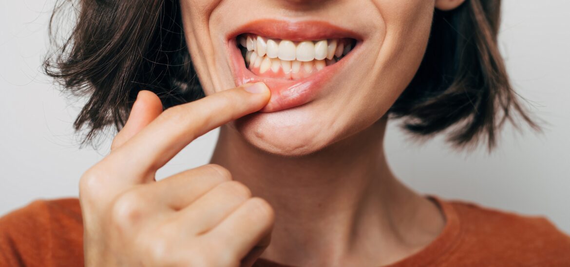 closeup shot of a woman's slightly inflamed gum line