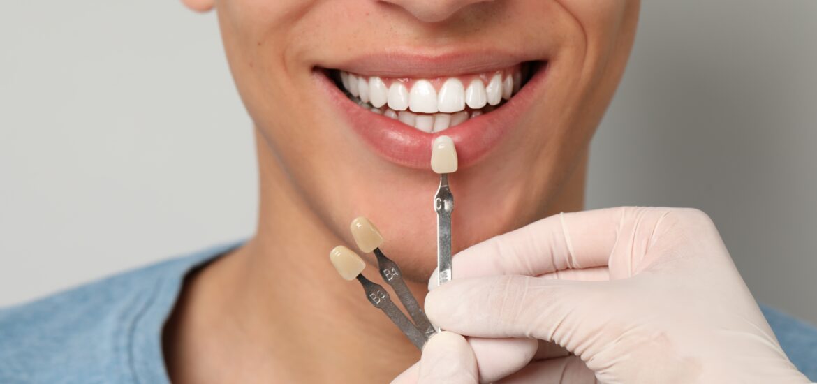 dentist checking dental veneer shades with a male patient