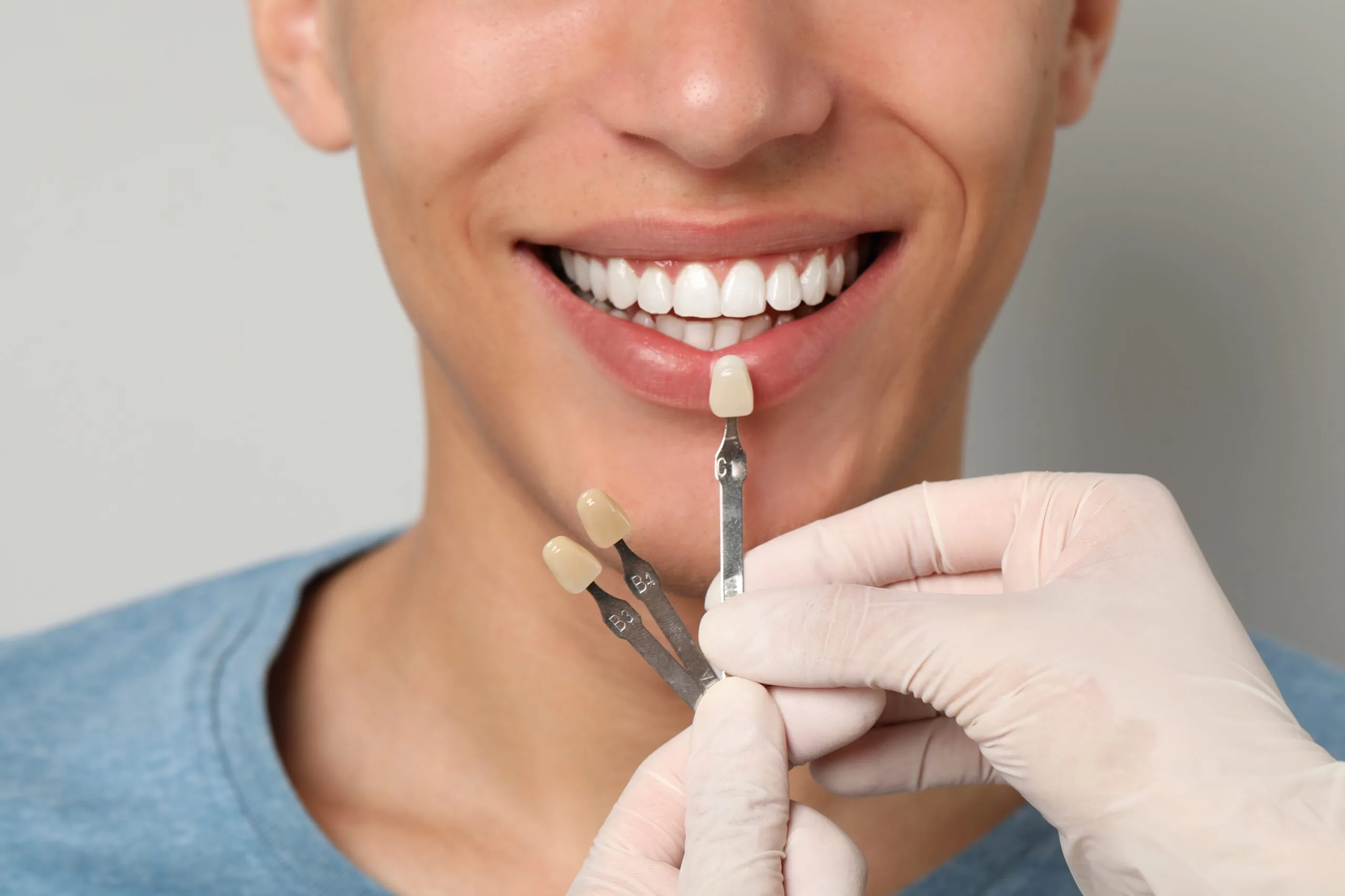 dentist checking dental veneer shades with a male patient