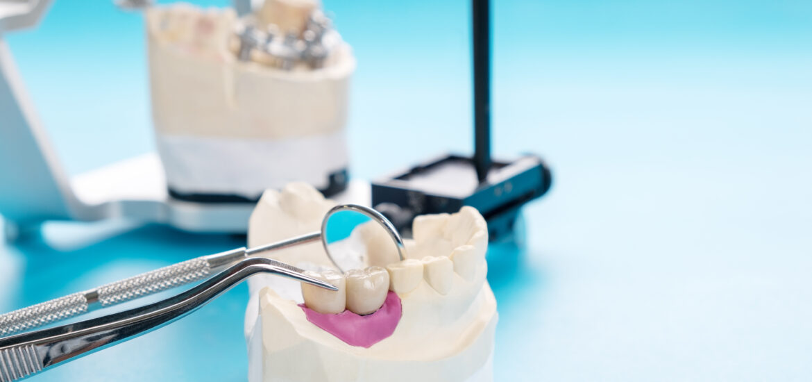 dentures being customized in lab