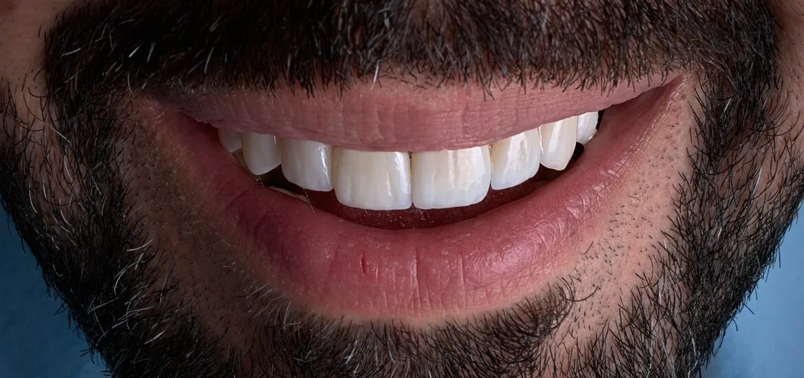 dental bonding improves the appearance of teeth, gums,